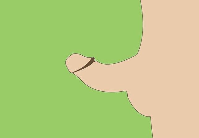 Krümmung vum Penis als Indikatioun fir chirurgesch Erweiderung